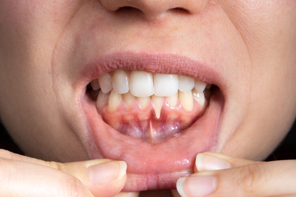 Preparing for teeth whitening with receding gums Cambridge